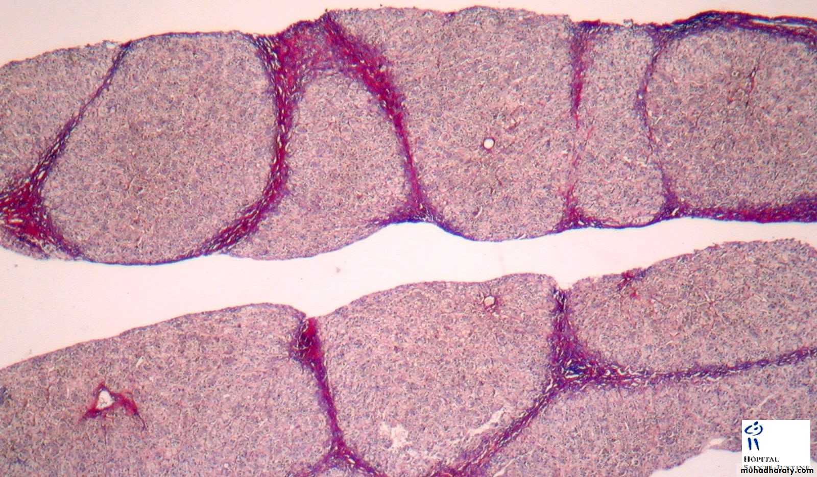 Liver and bone