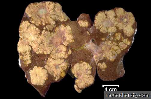 Liver and bone