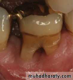furcation involvement