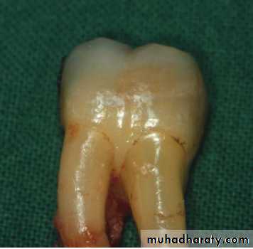 furcation involvement