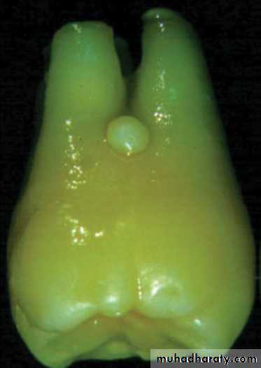 furcation involvement