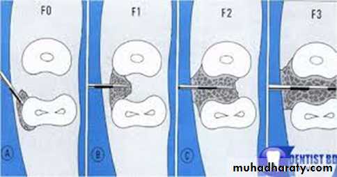 furcation involvement