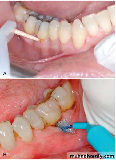 furcation involvement