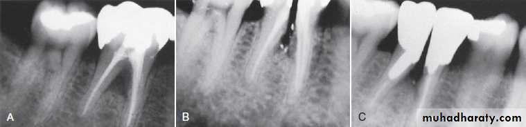 furcation involvement