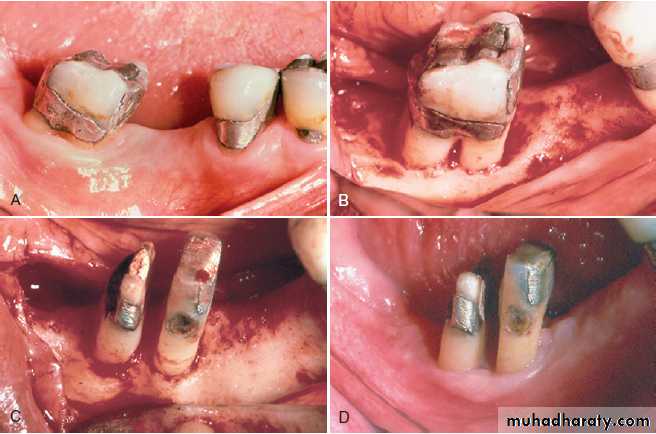 furcation involvement