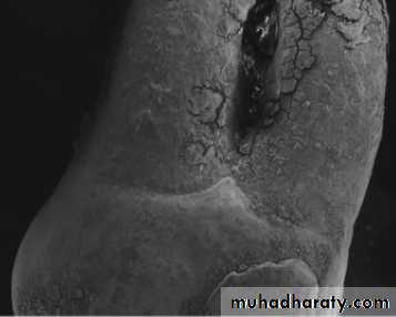 furcation involvement