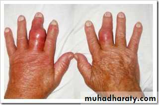 Gout