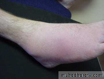 Gout