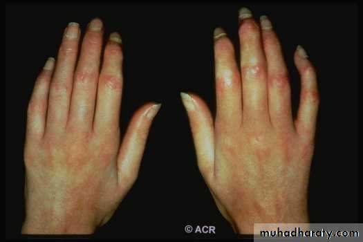 Gout