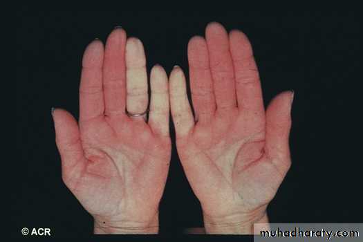 Gout