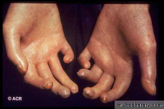 Gout