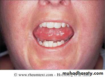Gout