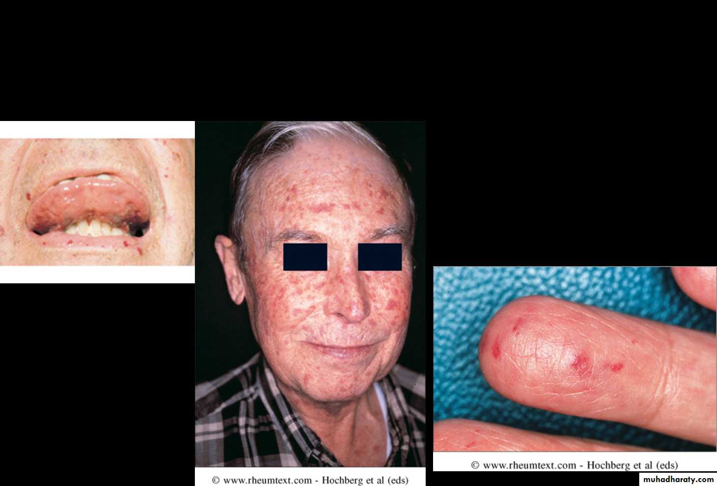 Gout