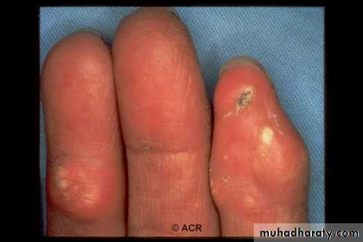 Gout