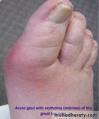 Gout