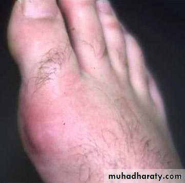 Gout