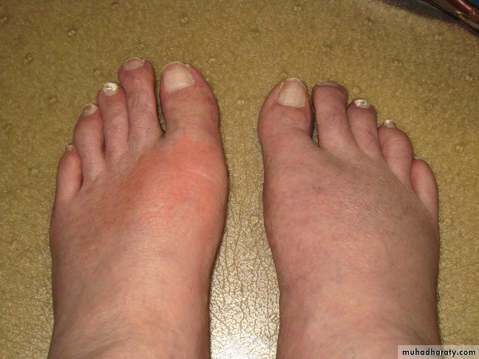 Gout