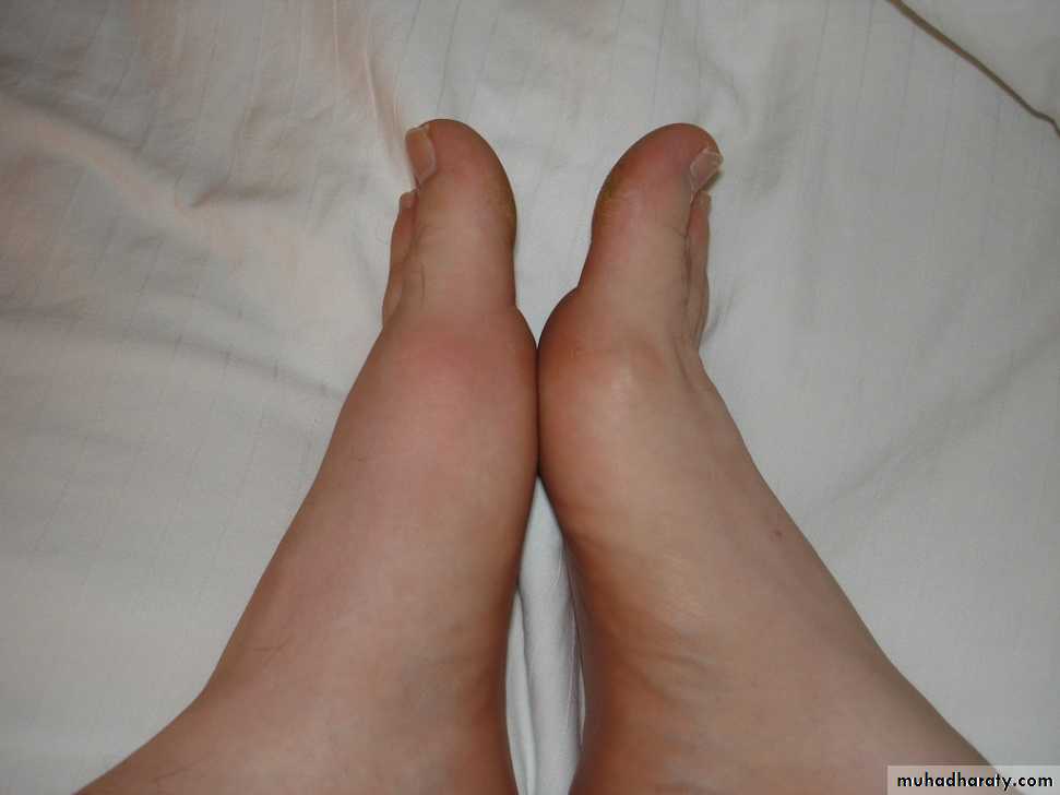 Gout