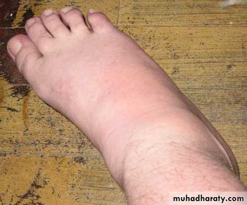 Gout