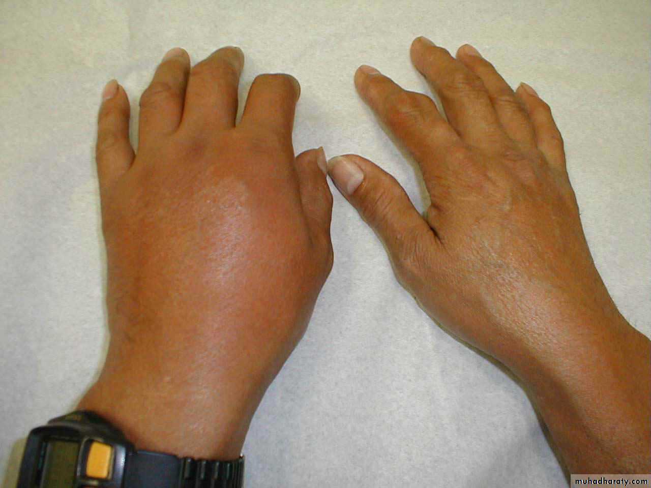 Gout
