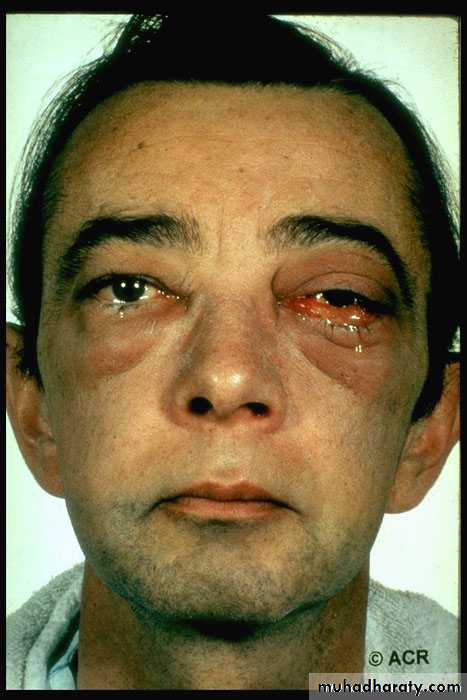 Vasculitis