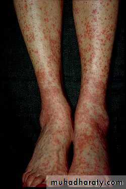 Vasculitis