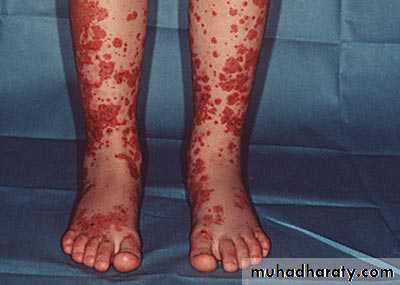 Vasculitis