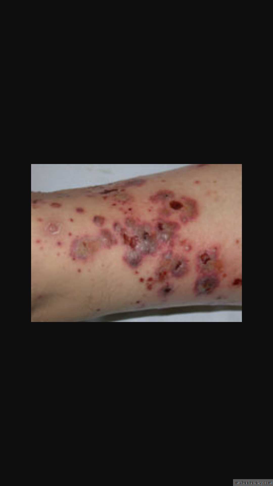 Vasculitis