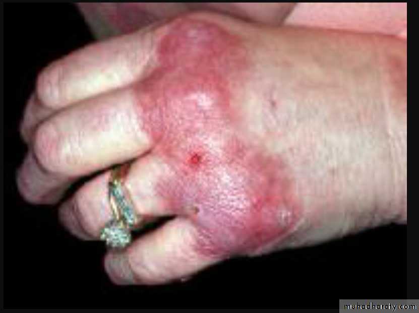 Vasculitis