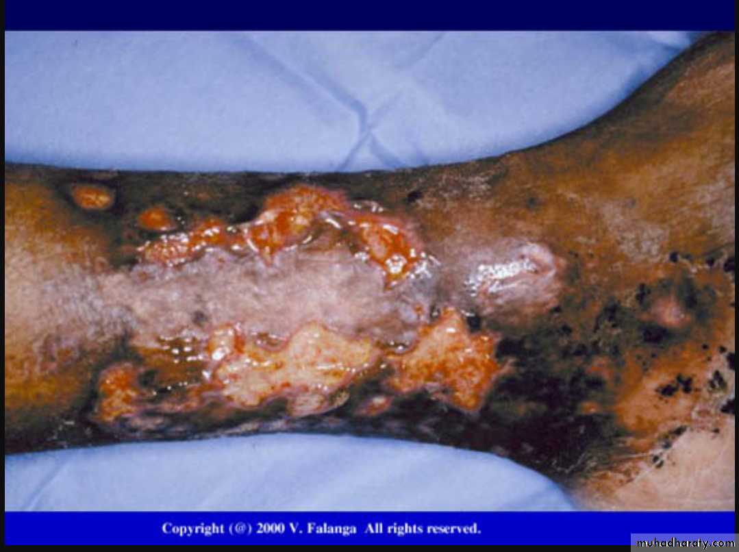 Vasculitis