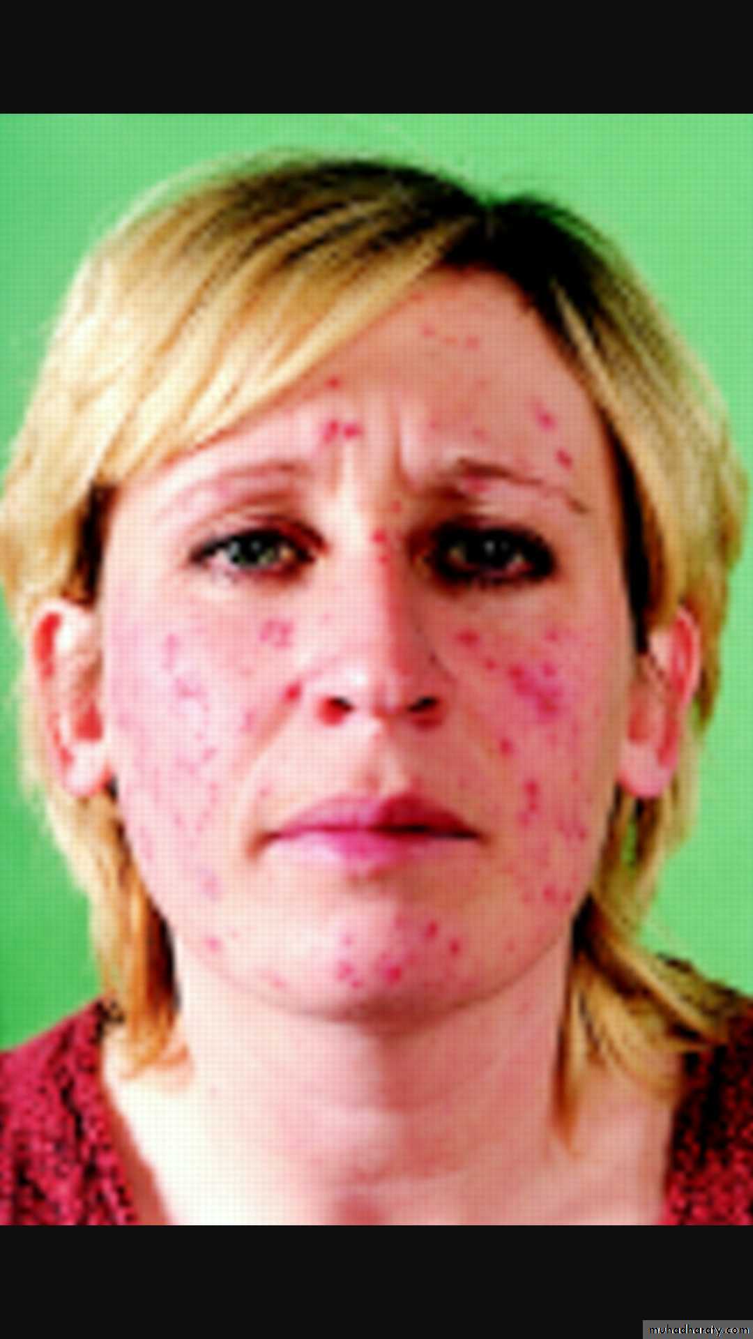 Vasculitis