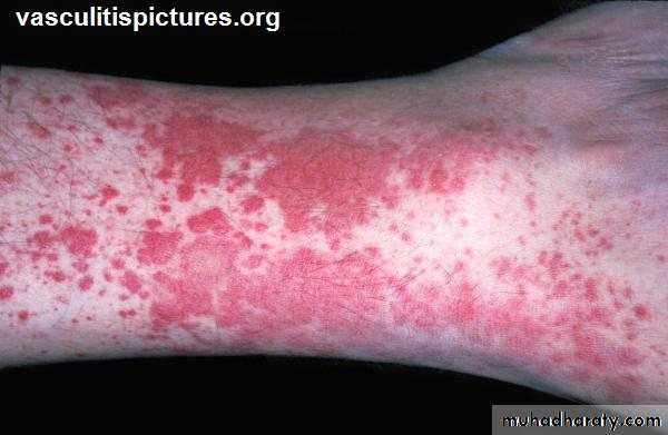 Vasculitis