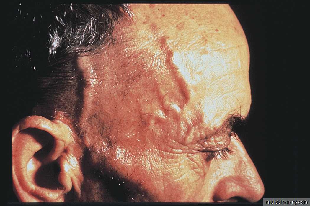 Vasculitis