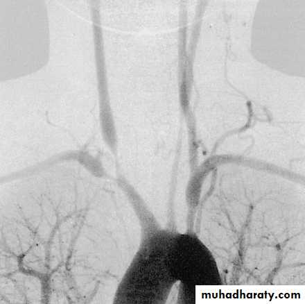 Vasculitis
