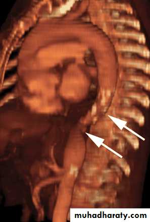 Vasculitis