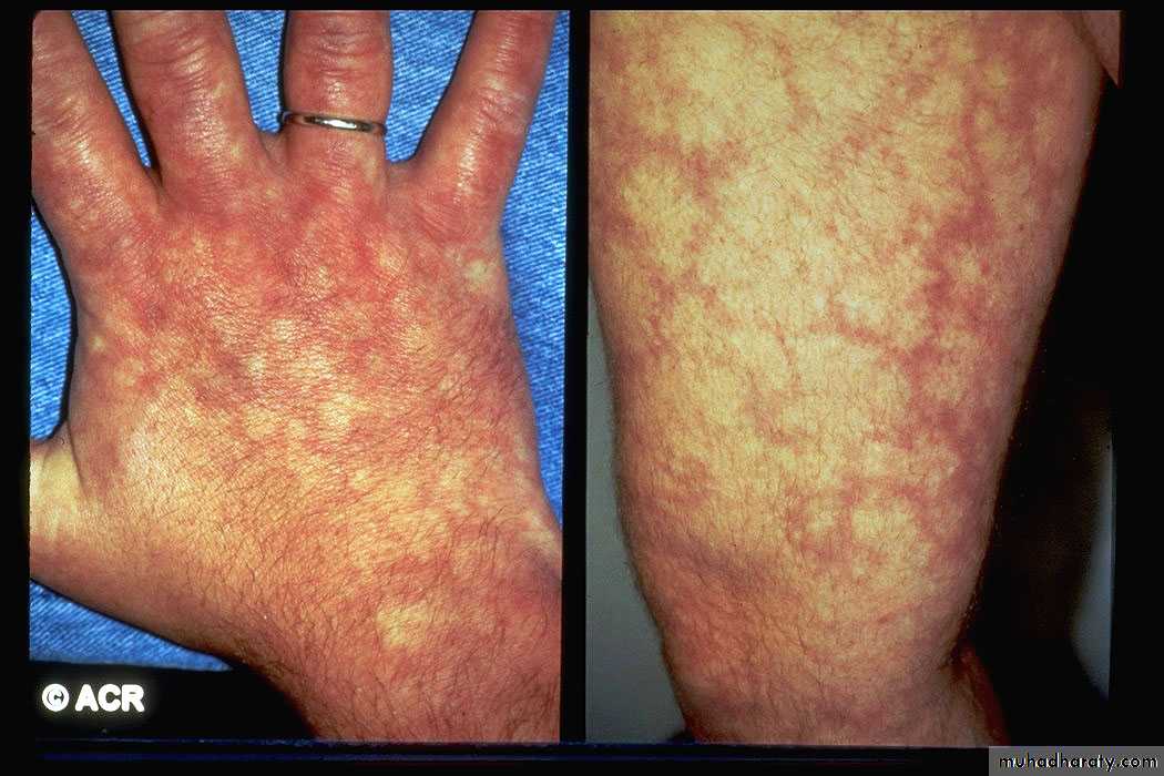 Vasculitis