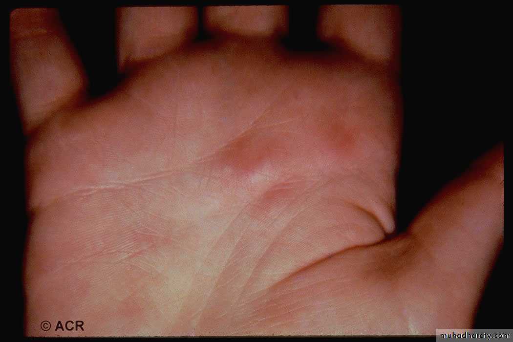 Vasculitis