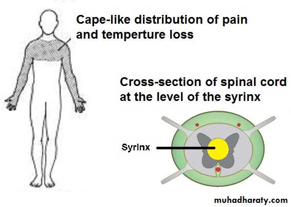 Syringomyelia