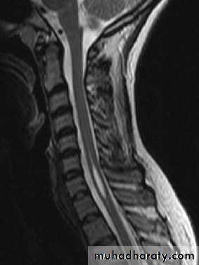 Syringomyelia