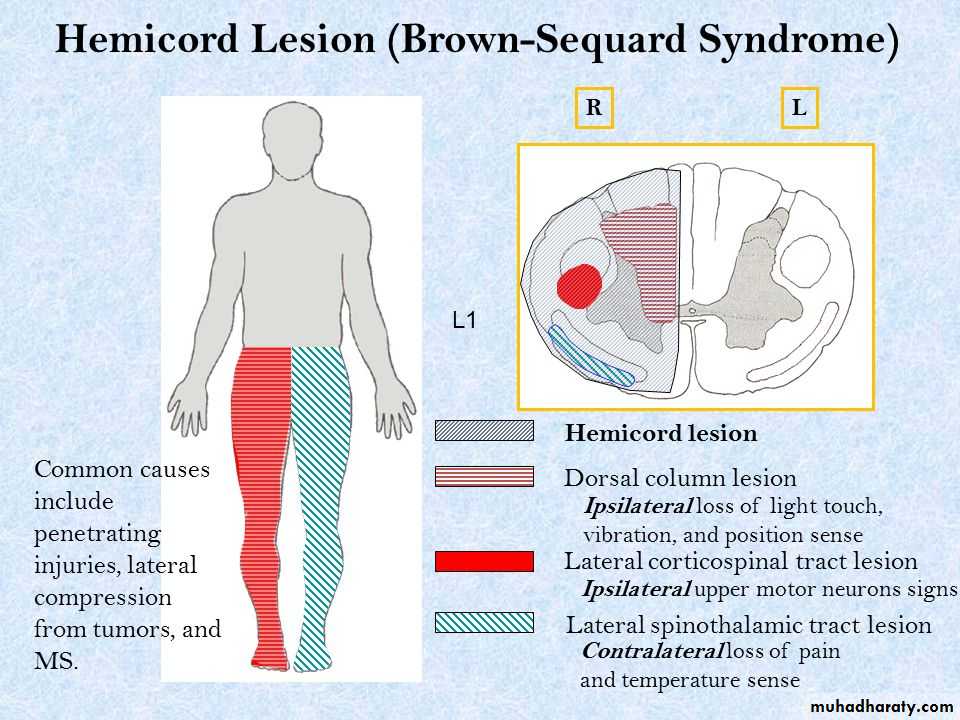 Syringomyelia