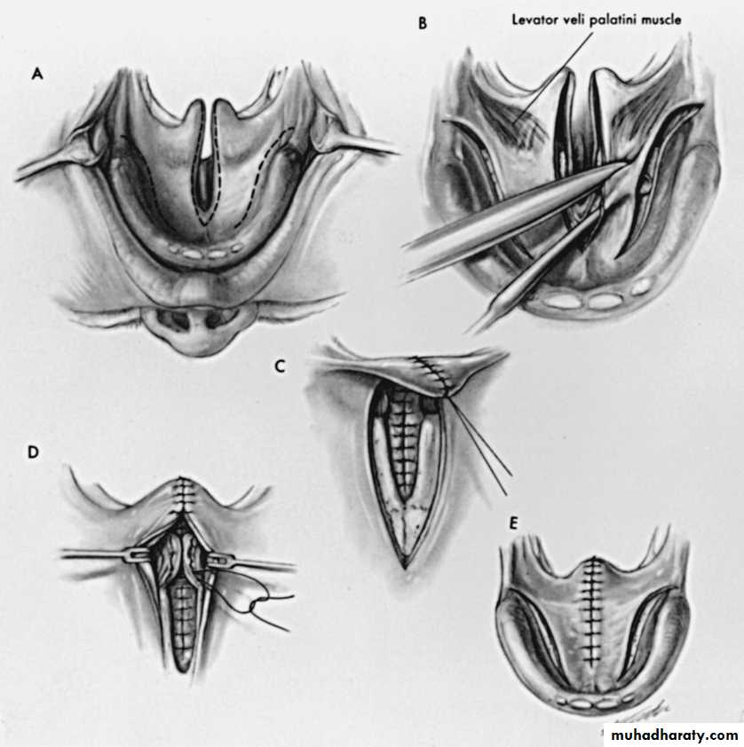 Cleft Palate & Cosmetic Operations
