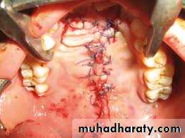 Cleft Palate & Cosmetic Operations