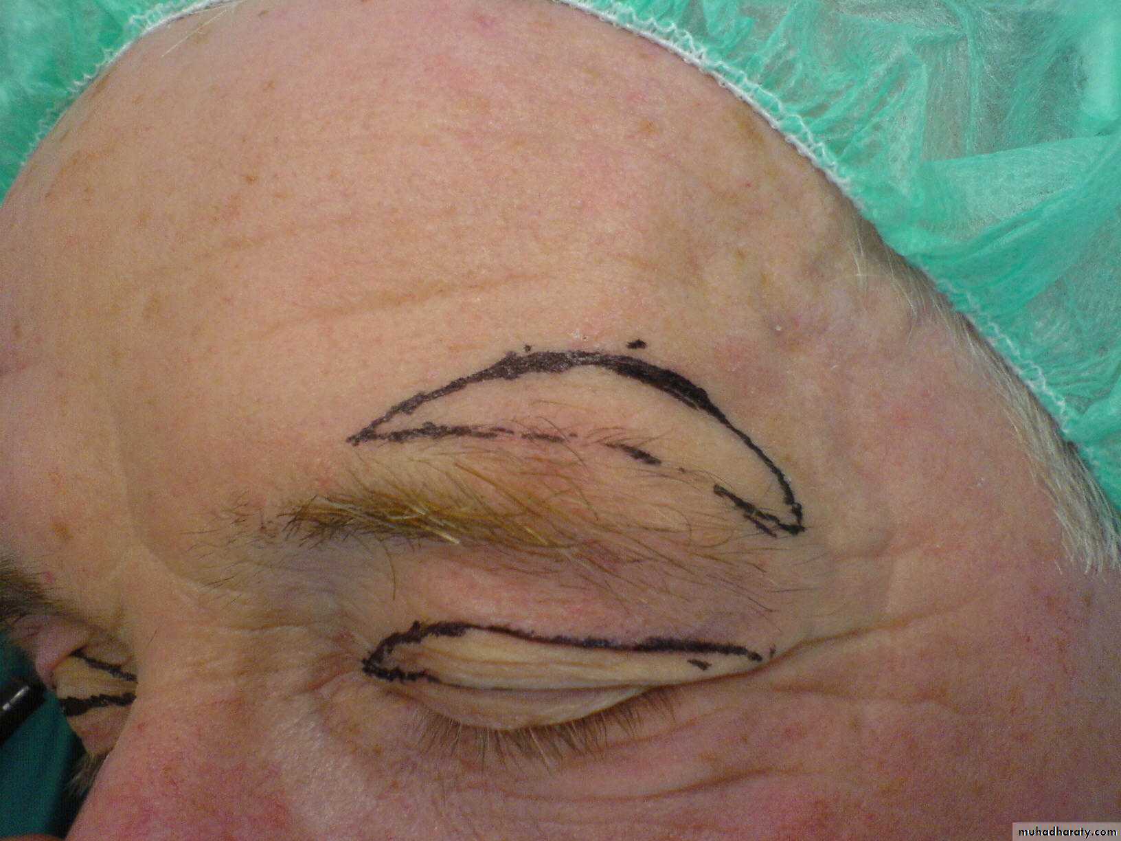 Cleft Palate & Cosmetic Operations