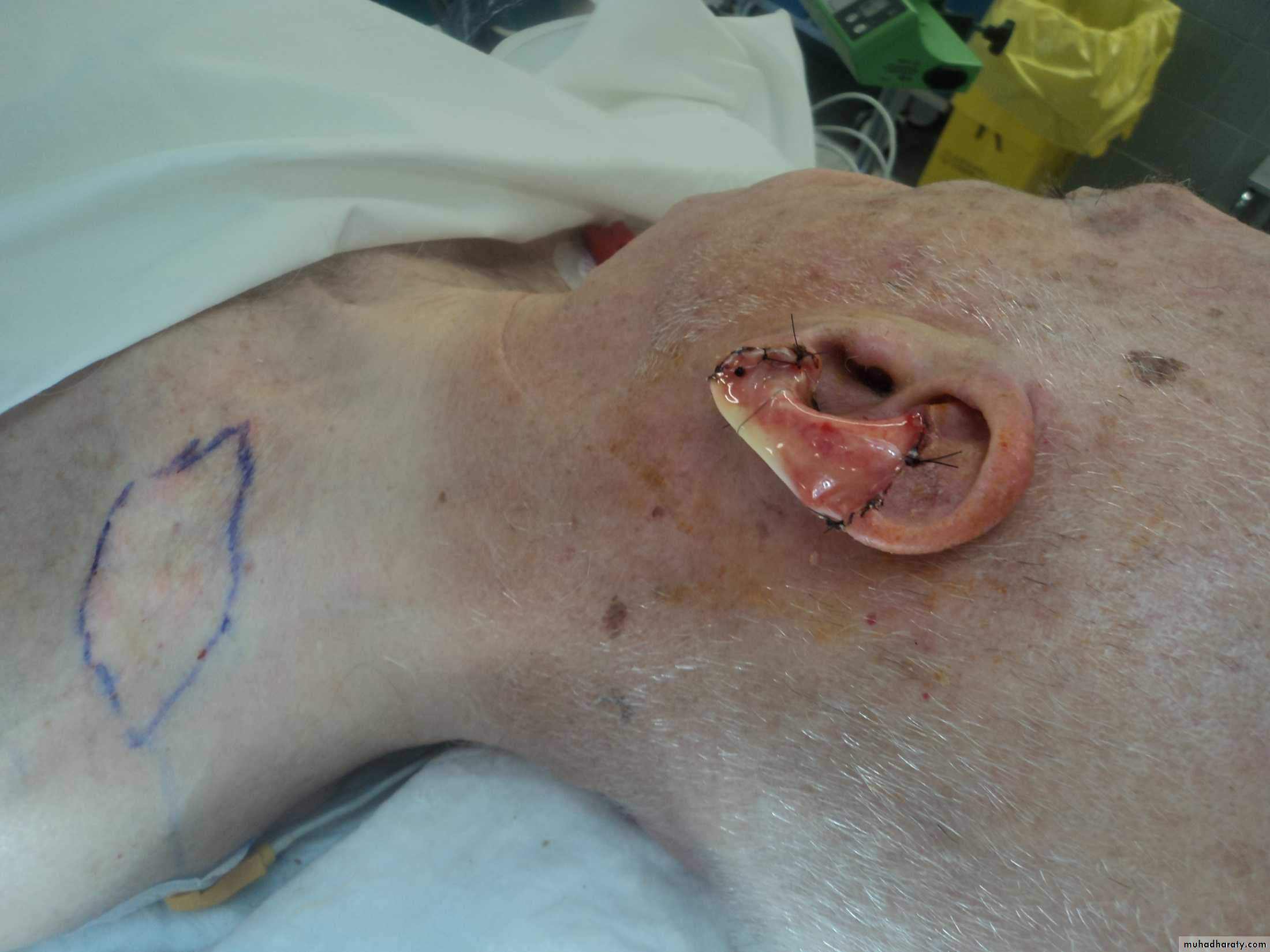 Cleft Palate & Cosmetic Operations