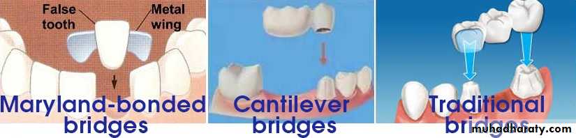 Crown and bridge