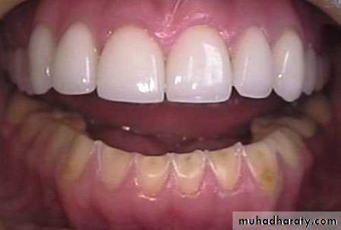 Treatment of dentin hypersensitivity
