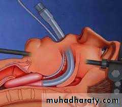 Airway Control