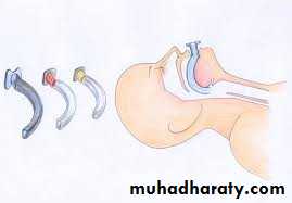 Airway Control