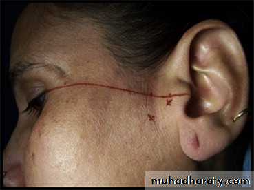orofacial pain