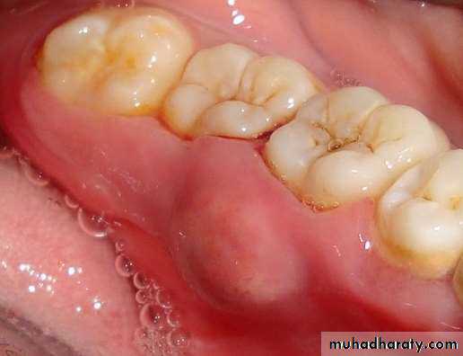 acute periodontitis